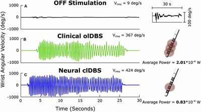 Perspective: Evolution of Control Variables and Policies for Closed-Loop Deep Brain Stimulation for Parkinson’s Disease Using Bidirectional Deep-Brain-Computer Interfaces